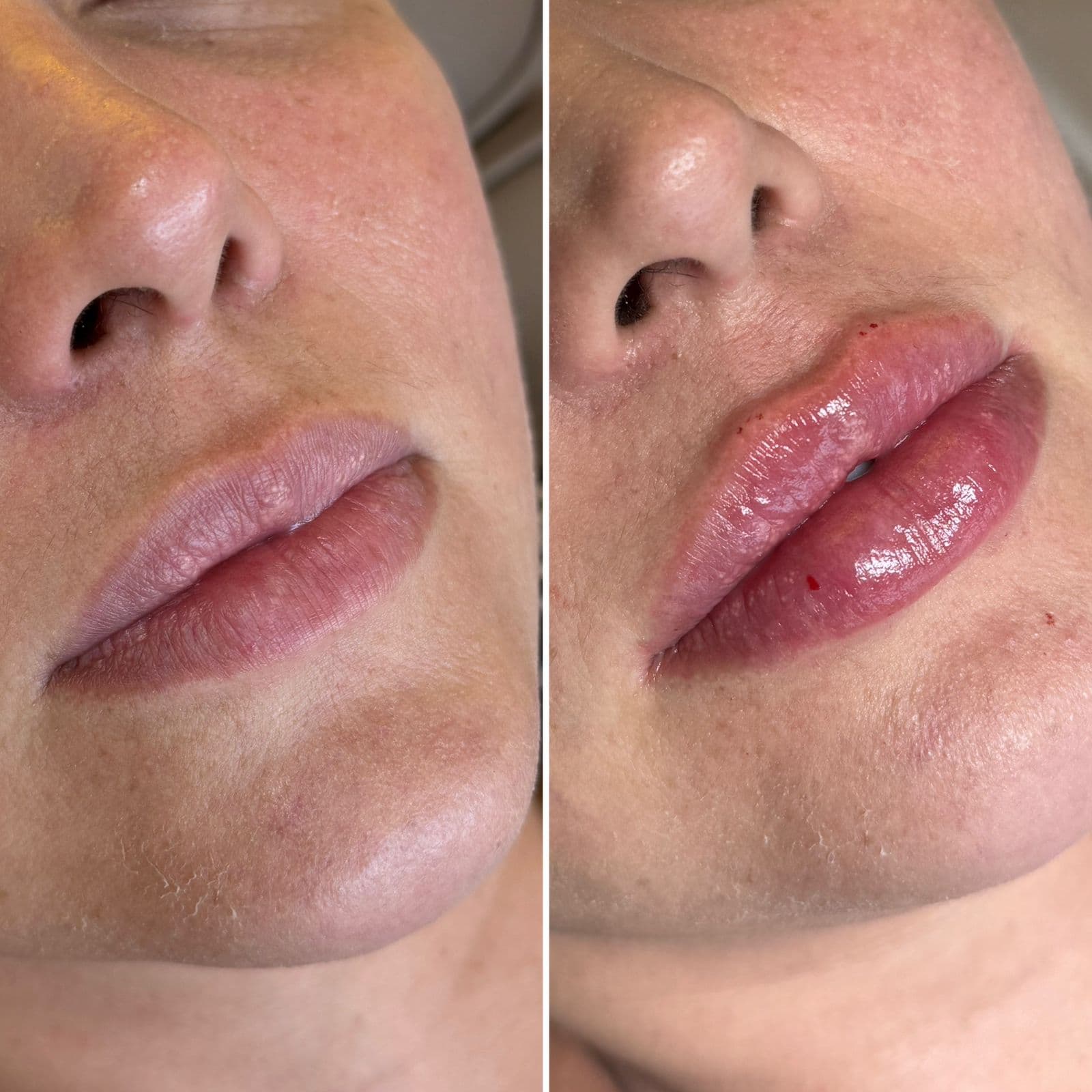 Preenchimento Labial